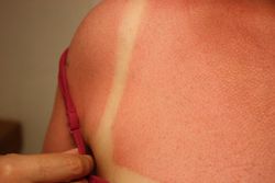 Thai sunburn